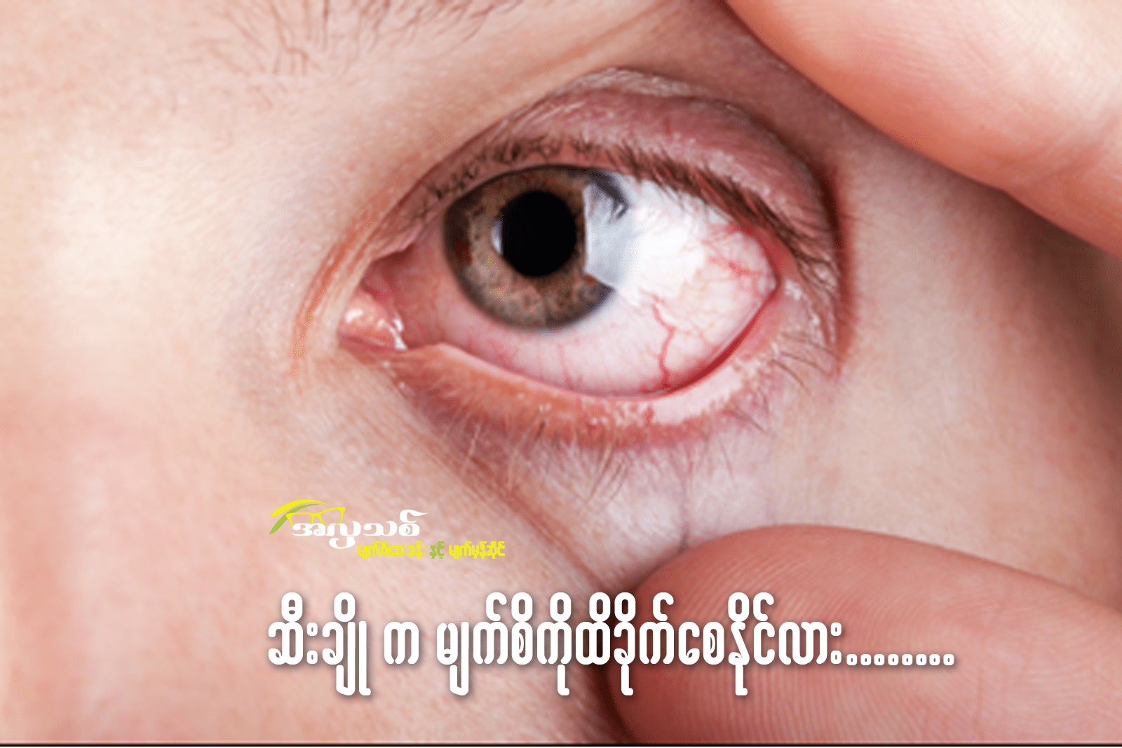 ဆီးချိုရောဂါကမျက်စိကိုထိခိုက်စေနိုင်လား? အပိုင်း (၂) အတွင်းတိမ်ဖြစ်ခြင်း